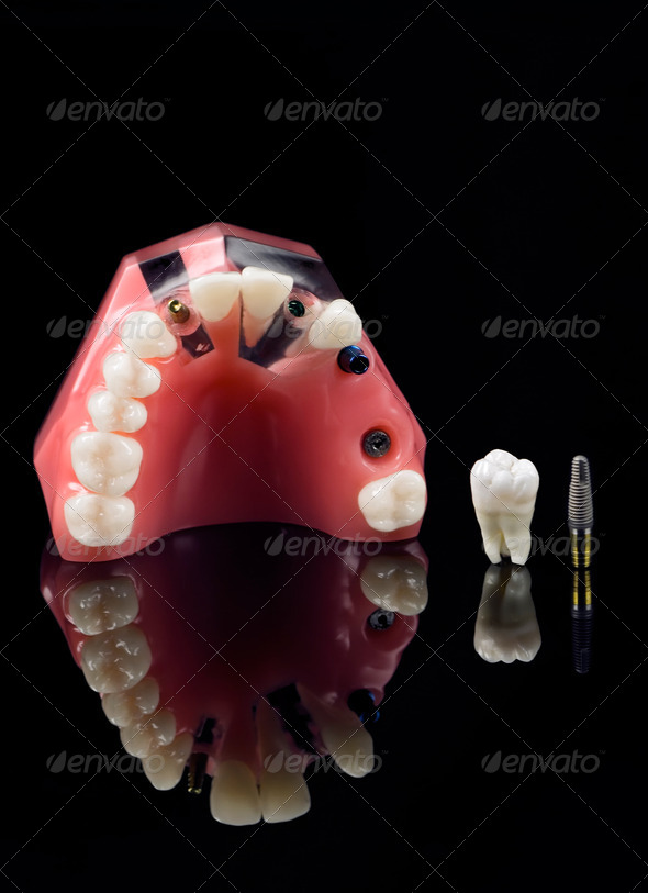 Real Human Wisdom tooth, Implant Dental and Plastic Teeth Model - Stock Photo - Images