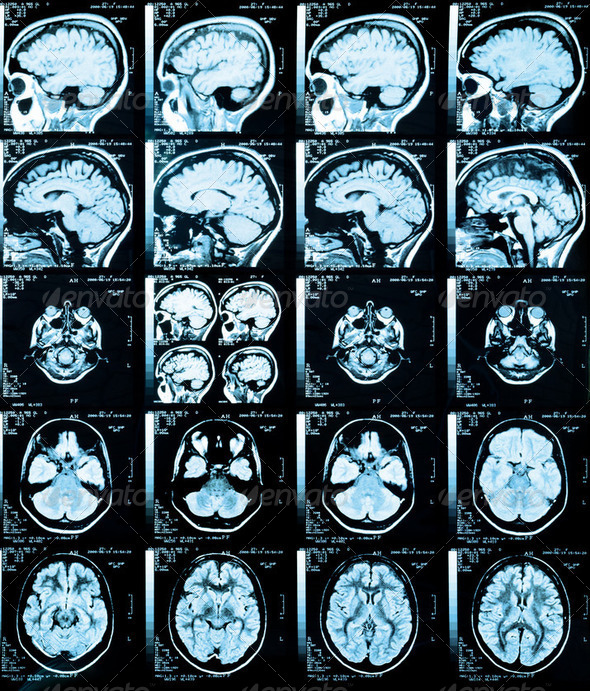 X-Ray Brain - Stock Photo - Images