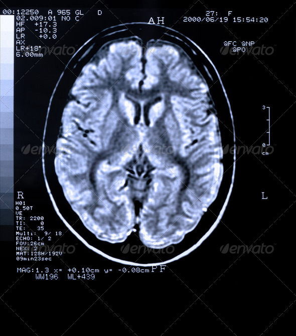 XRay Brain - Stock Photo - Images