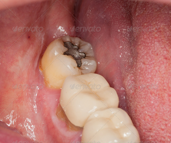 Macro image of filled teeth - Stock Photo - Images