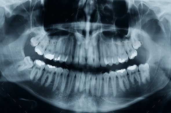 Dental xray (Misc) Photo Download