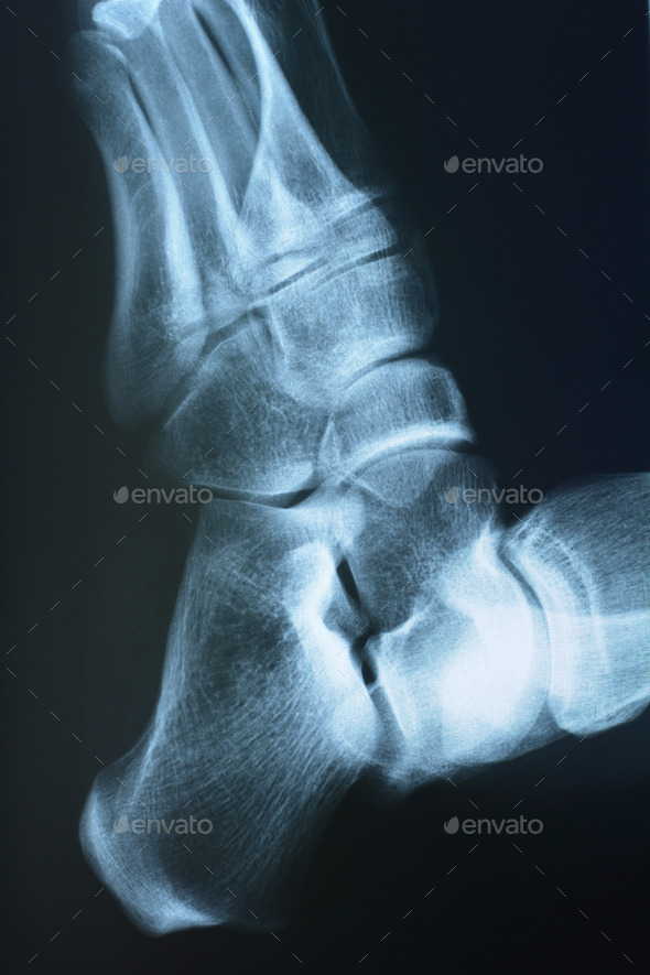 Foot xray (Misc) Photo Download