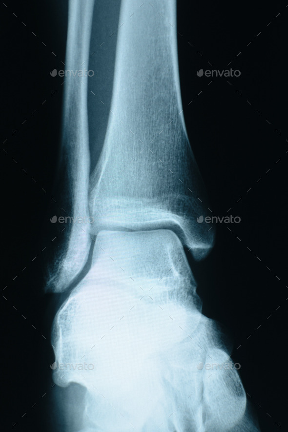 heel xray (Misc) Photo Download