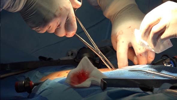 VideoHive Surgical Suture Or Stitches 2 9715549 VideoHive Surgical Suture Or Stitches 2 9715549
