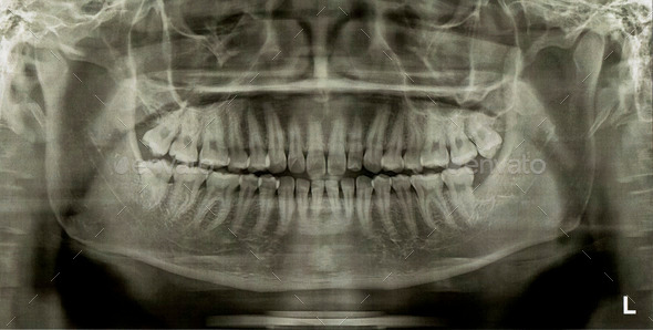 Dental Radiograph X-Ray
