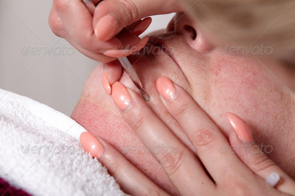 Eliminate skin blemishes
