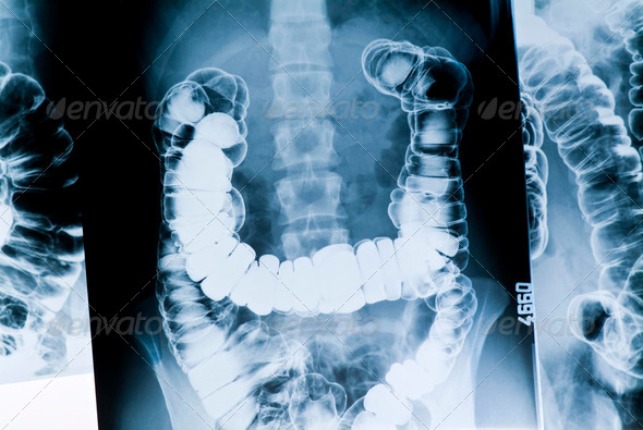 radiography of the intestine