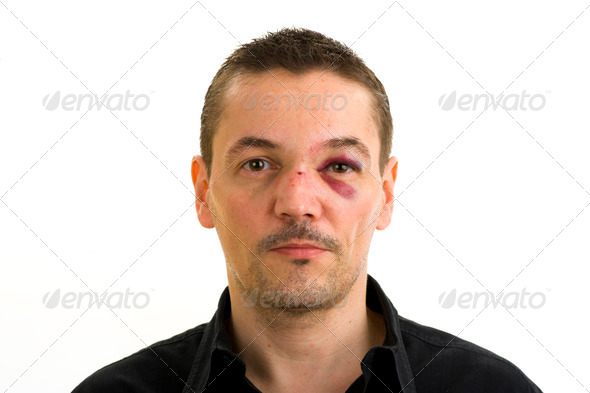 man with crooked, broken nose und black eye