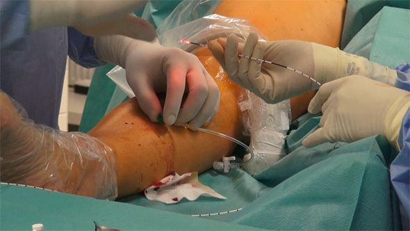 Laser Surgery for Varicose Veins Laser Surgery for Varicose Veins