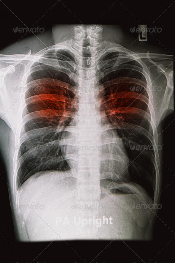 chest X-rays image show lungs and pulmonary disorders