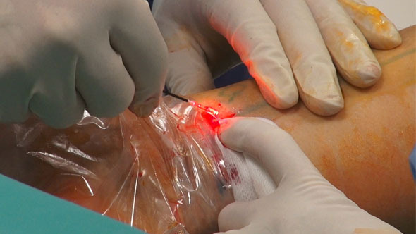 Laser Surgery- Removed From The Vein Laser Laser Surgery- Removed From The Vein Laser