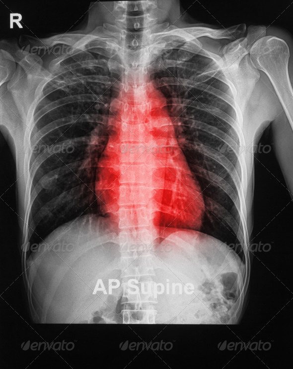 the x-ray image of a human chest