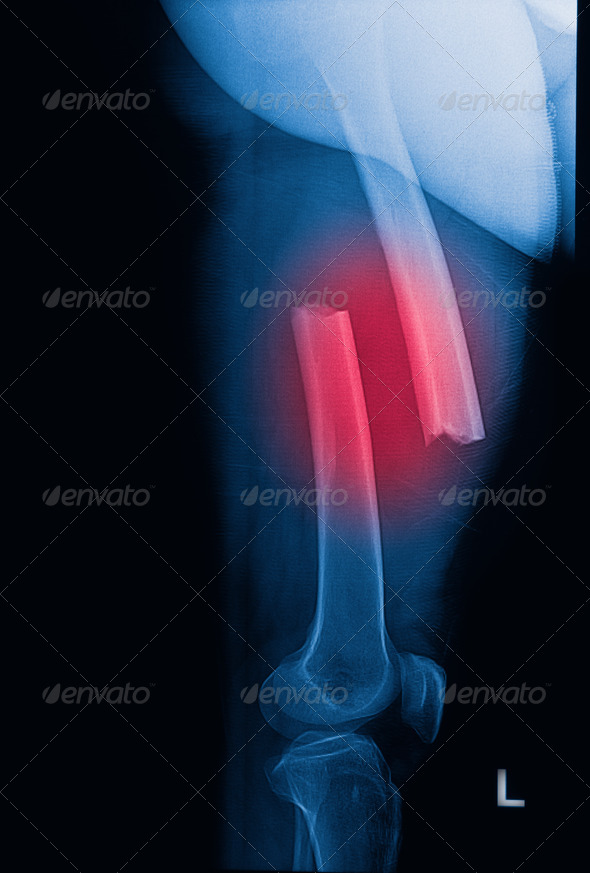 broken human thigh x-rays image ,lelf leg fracture