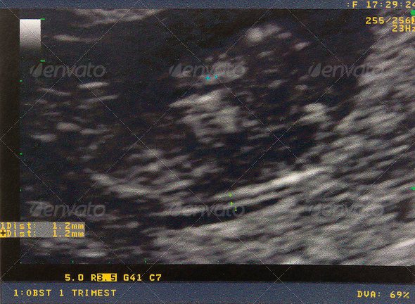 Ultrasound in the first trimester