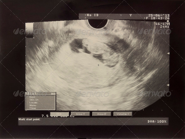 Ultrasound in the first trimester