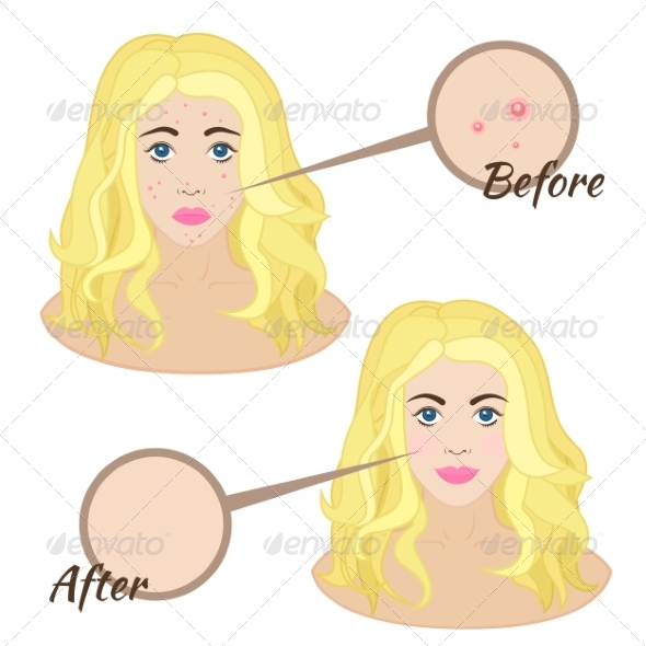 GraphicRiver Girl Face with Acne 8295152 GraphicRiver Girl Face with Acne 8295152