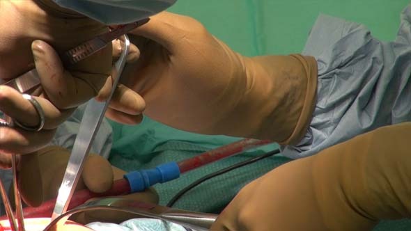 Hip Replacement and Doctor s Hands 3 Hip Replacement and Doctor s Hands 3